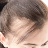 Hair loss – treatment, examination. The causes of baldness