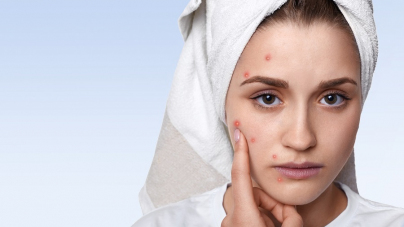 All About Pimples