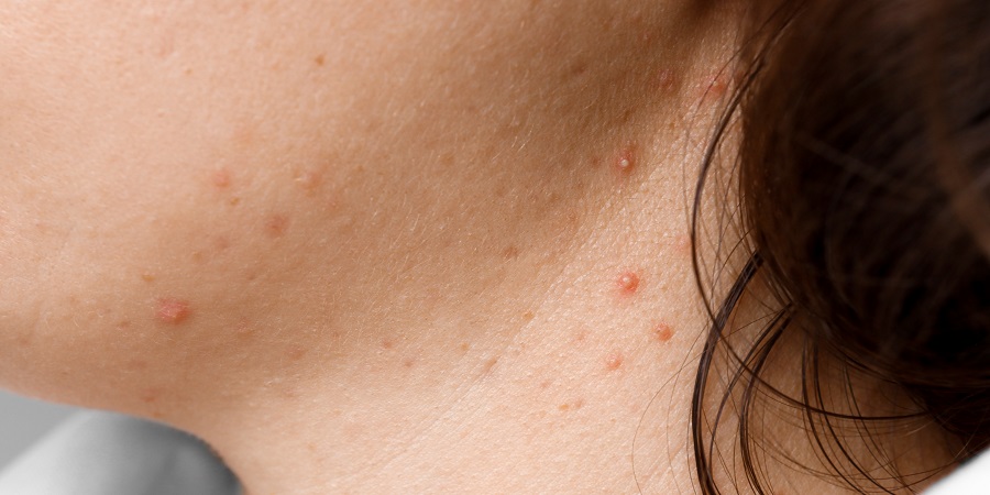 Pimple on neck