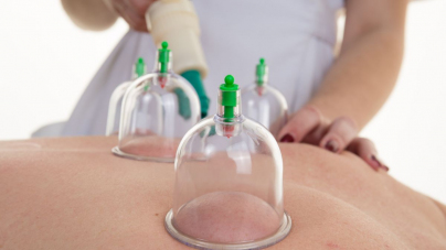 Cupping, an alternative medicine for pain and blemishes