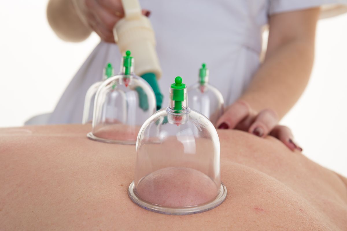 Cupping, an alternative medicine for pain and blemishes