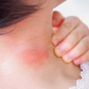 Tiger mosquito bite: what symptoms does it cause