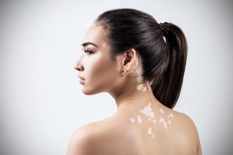 Causes of white spots on the skin Home Health Care