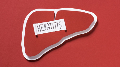 hepatitis a