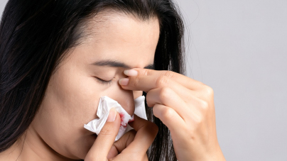 nosebleed-woman-suffering-from-nose-bleeding-using-tissue-paper