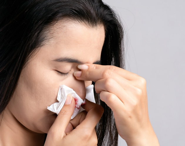 nosebleed-woman-suffering-from-nose-bleeding-using-tissue-paper